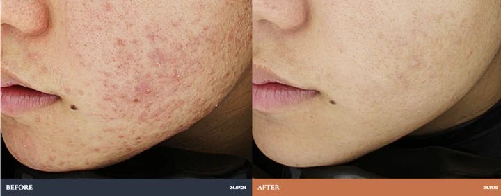 Acne / pores: before-and-after photographs supplied by Ollium Clinic