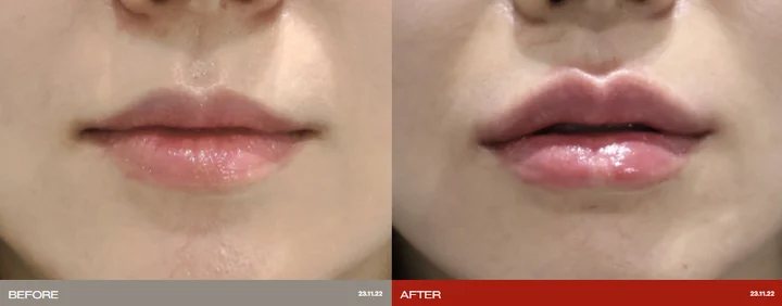 Filler: before-and-after photographs supplied by Ollium Clinic