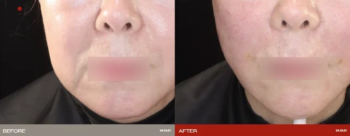 Lifting: before-and-after photographs supplied by Ollium Clinic