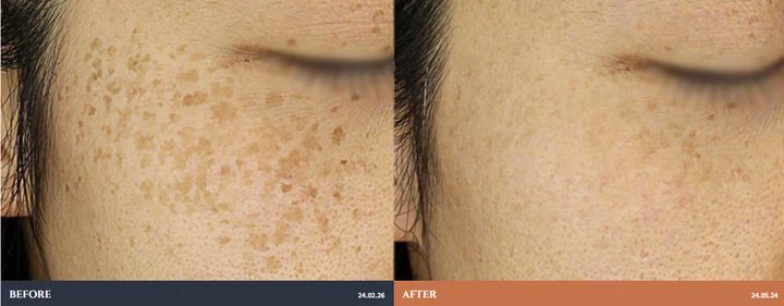 Pigmentation: before-and-after photographs supplied by Ollium Clinic